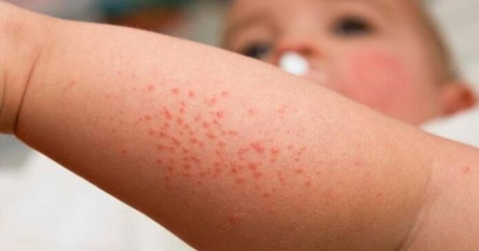 Skin rash as a symptom of a parasitic infection