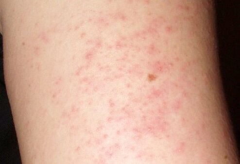 Itchy rashes are a symptom of the presence of worms in the liver