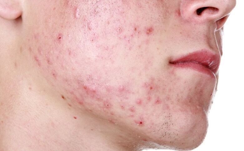 Rash on the face caused by parasites