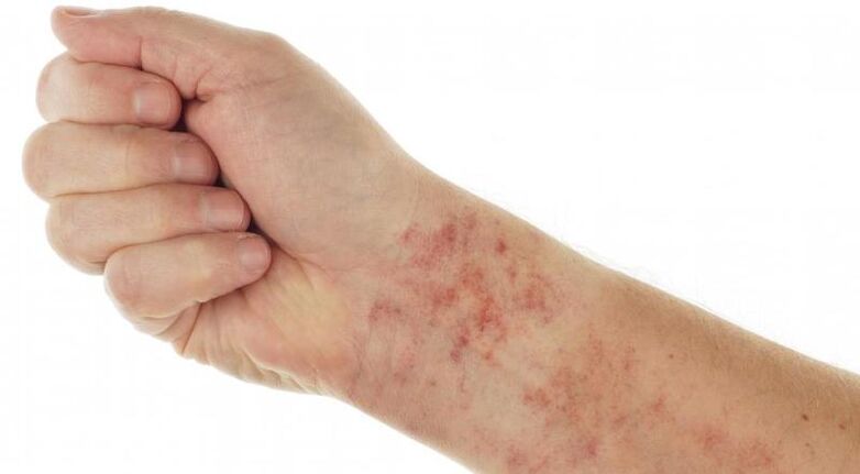 Rashes in the presence of parasites in the body